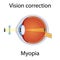 Vision Correction of Myopia Illustration. Eyesight Disorders. Eyes Defect Corrected by Concave Lens Concept. Detailed