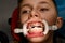 Visit to the orthodontist, installation of braces on the upper teeth, white retractor on the lips of the child.