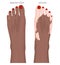 Vitiligo_African American foot with colored nails