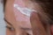 Vitiligo. A close-up portrait of a woman with no skin pigmentation on her forehead. Girl smears sunscreen on a white