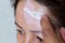 Vitiligo. A close-up portrait of a woman with no skin pigmentation on her forehead. Girl smears sunscreen on a white
