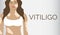 Vitiligo Skin Illness Banner Background