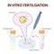 In vitro fertilization