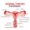 Vulvovaginal candidiasis or vaginal yeast infection.Vector illustration