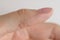 Wart on hand. The concept of treating warts and other skin defects. Close-up of a wart on a finger, a benign growth on