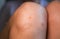 Wart on the knee. Mole on woman`s leg. Papilloma problem. Skin disease. Medical treatment photo