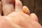 Wart verrucae plantares on a toe on a foot as a typical skin disease