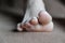 Warts corns on woman foot sole before appointment with a dermatologist.brown background