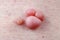 Warts, polyps and moles grow on human skin all their life