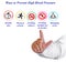 Ways to Prevent High Blood Pressure