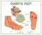 Web Diabetic Foot. Diabetes symptoms.