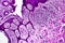 Well-differentiated intestinal adenocarcinoma, light micrograph
