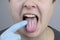 White curd on the tongue. A physician or gastroenterologist examines a manâ€™s tongue. Patient has poor oral hygiene or a symptom