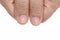 White spots and Vertical ridges on the fingernails