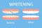 Whitening teeths before and after, stomatology, dental concept isolated. Healthcare and beauty stock