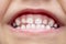 A wide-open child`s mouth with beautiful white teeth, close-up. Concept: pediatric dentistry, brushing your teeth with toothpaste,
