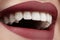 Wide smile of young beautiful woman, perfect healthy white teeth. Dental whitening, ortodont, care tooth and wellness