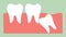 Wisdom tooth angular or mesial impaction