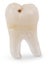 Wisdom Tooth with Cavity