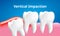 Wisdom tooth Vertical impaction with inflammation affect , Dental care concept, Realistic Vector