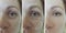 Woman adult face wrinkles aging  before and after result procedure lifting regeneration orrection treatment