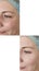 Woman adult face wrinkles before after beautician regeneration treatment rejuvenation collage correction