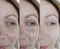 Woman adult face wrinkles effect aging before and after result procedure lifting regeneration orrection treatment