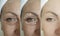 Woman adult face wrinkles before and after result procedure lifting regeneration orrection treatment