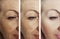 Woman adult skin wrinkles removal before after collage cosmetology regeneration treatments contrast