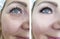 Woman adult  wrinkles before and after collage procedures