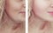 Woman adult wrinkles double chin before and after collage procedures