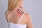 Woman with allergy symptoms scratching shoulder on grey background