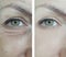 Woman bag eyes puffy wrinkles before and after rejuvenation treatment