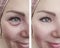 Woman beauty wrinkles removal lift antiaging cosmetology before and after correction procedures