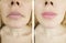 Woman  caucasianwrinkles sagging difference   treatment rejuvenation tension before and after correction