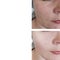 Woman circles skin face correction  therapy   collage   effect tension lifting before after antiaging