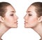 Woman before and after cosmetic nose surgery