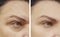 Woman difference wrinkles beautician mature face patient before and after lifting cosmetic procedures contrast