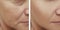 Woman difference wrinkles beautician mature patient before and after lifting cosmetic procedures contrast