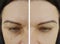 Woman difference wrinkles beautician pigmentation face patient before and after lifting cosmetic procedures