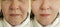 Woman double chin before and after collage oval facelift effect treatment sagging problem