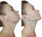 Woman double chin cosmetology   before  after contour  comparison    treatment