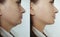 Woman double chin removal   before and after treatment aesthetic