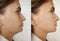 Woman double chin before and after treatment aesthetic