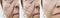 Woman elderly face skin wrinkles cosmetology rejuvenation before and after procedures, arrow