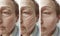 Woman elderly face wrinkles correction mature contrast before and after procedures, arrow