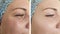 Woman elderlyface wrinkles  correction before after lifting biorevitalization regeneration antiaging treatment