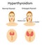 Woman with enlarged hyperthyroid gland. Vector illustration.