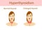 Woman with enlarged hyperthyroid gland. Vector illustration.