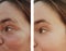 Woman eye wrinkles before and after dermatology cosmetic procedures